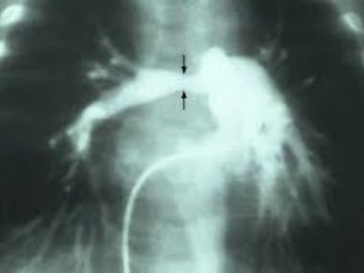 Stenoza plućne arterije predstavlja opstrukciju na nivou izlaznog trakta desne komore i relativno je česta urođena srčana malformacija.