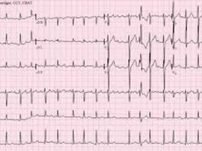 Atrijalna fibrilacija (treperenje pretkomora) predstavlja poremećaj srčanog ritma koji nastaje u pretkomorama.  