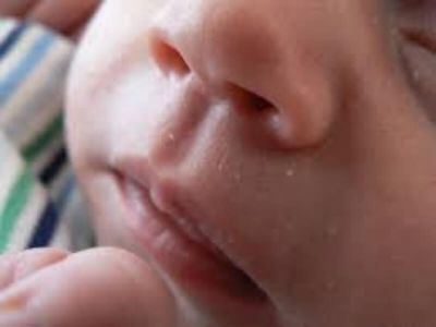 Erizipel nosa (crven vetar nosa) predstavlja akutni streptokokni dermatitis nosa.