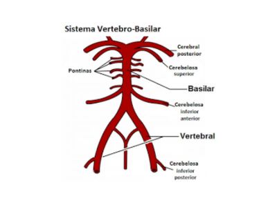 Sindrom poremećaja cirkulacije krvi u vertebro - bazilarnom sistemu je definisan pre skoro pola veka.