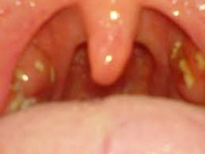 Ludwigova angina je zapaljenje prostora ispod donje vilice i jezika (submandibularni i sublingvalni prostori) koja se brzo razvija, može ugroziti život, a obično se javlja kod mlađih osoba i dece kao rezultat zubnih infekcija.