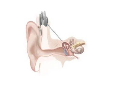 Akutna gluvoća (hypoacusis sensoneuralis acuta) predstavlja nagli nastanak nagluvosti ili gluvoće kod bolesnika koji do tada nisu imali smetnje sa sluhom.