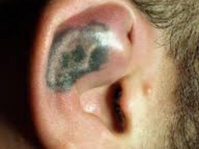 Hematom (othaematoma) je posttraumatski ili spontani serozno krvavi izliv između perihondrijuma i hrskavice ušne školjke.