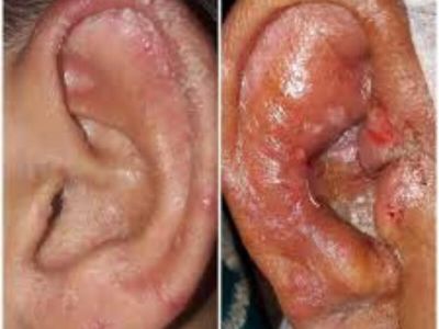 Otomycosis je infekcija uzrokovana gljivicama i ograničena je na spoljašnji ušni kanal.