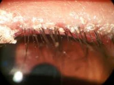 Zapaljenje rubova kapaka (Blepharitis)