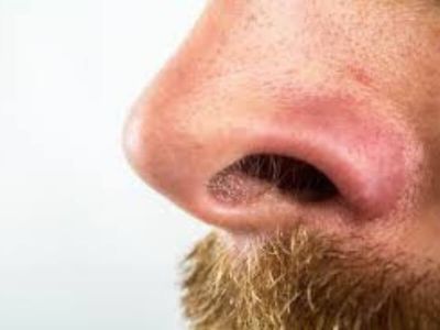 Apsces nosne pregrade nastaje ukoliko dođe do infekcije hematoma. On može uzrokovati perihondritis septuma, nekada i kolikvaciju hrskavice, usled čega može doći do deformacije nosne piramide u smislu lordoze.