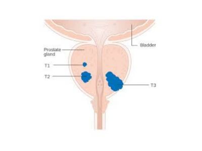 Stručnjaci razvijaju lokalizovane i manje agresivne metode lečenja raka prostate, kako bi uticaj na urinarni trakt i na seksualnu funkciju bio što manji.