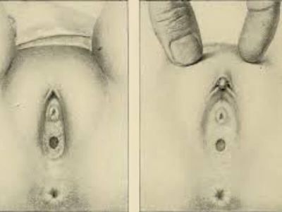 Ulcus vulvae acutum predstavlja akutno ulcerozno oboljenje nedovoljno poznate etiopatogeneze, koje zahvata male i velike usne. Pretežno se javlja kod mladih žena i devojaka pre prvog seksualnog odnosa.