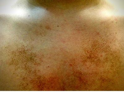 Terra firma forme dermatosis (TFFD) Veoma često nam u odrinaciju dolaze zbrinuti pacijenti I roditelji dece, a zbog promena na koži u vidu braonkastih mrlja koje se nalaze na vratu, grudnom košu ramenima, zglobovima a koje ne prolaze na upotrebu vode I sapuna prilikom običnog tuširanja?!