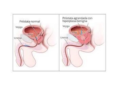 Beniptoma.gna hiperplazija prostate (BHP) je nemaligni, prekomerni rast ćelija prostate. Kako se hiperplazija razvija, tako se uretra (cev kojom urin izlazi iz bešike) postepeno sužava što dovodi do velikog broja neugodnih i uznemirujućih simptoma.