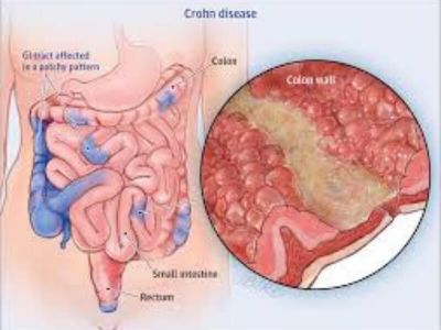 Kronova bolest (Morbus Crohn) Kronova bolest je nespecifično zapaljenjsko oboljenje digestivnog trakta. Ova bolest može da zahvati bilo koji njegov deo, u velikoj većini slučajeva ileum (deo tankog creva) i kolon (debelo crevo).