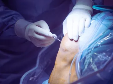 Šta je artroskopija i kada se primenjuje?